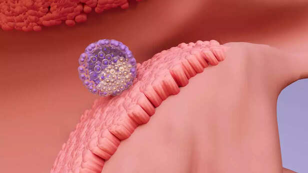 Process of Implantation