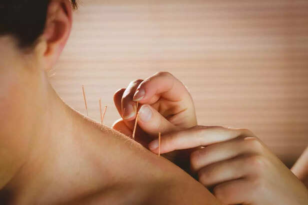 Acupuncture technique