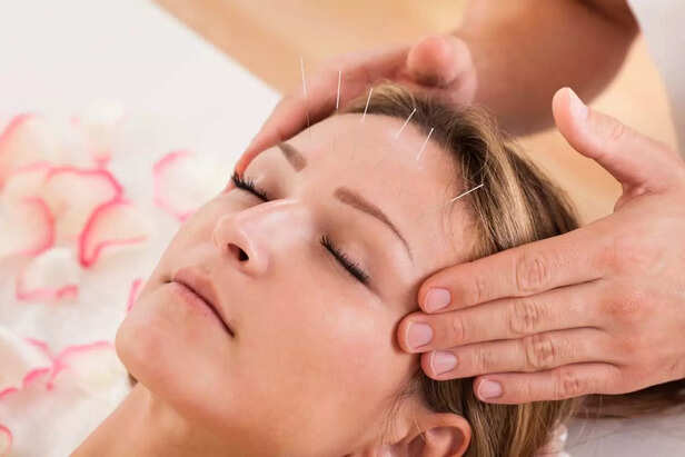 Acupuncture treatment