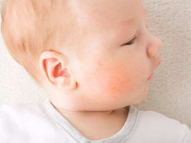 baby allergy