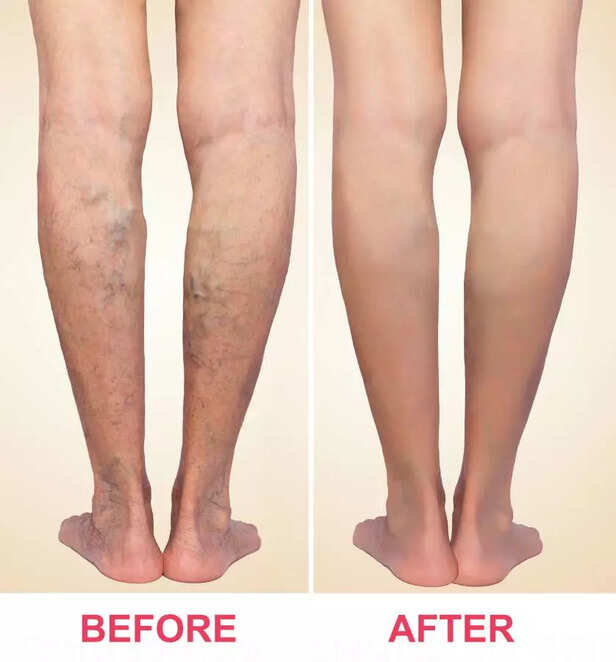 Treatment of varicose before and after. Varicose veins on the legs.