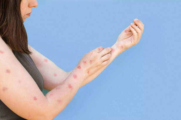 Woman scratches her hands with rash, red spots blisters. Monkeypox new disease dangerous over the world. Patient with Monkey Pox. Close up rash, human with Health problem.