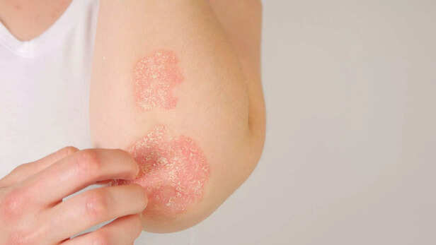 female patient suffering from psoriasis skin disease