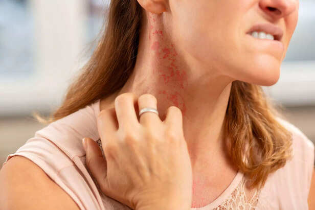 Blond woman wearing ring on finger having rash on neck