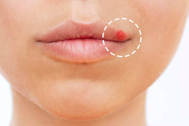 Herpes on the lip. Blisters on the mouth of a young woman