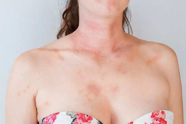 Allergic skin reaction on the female neck and face - red rash