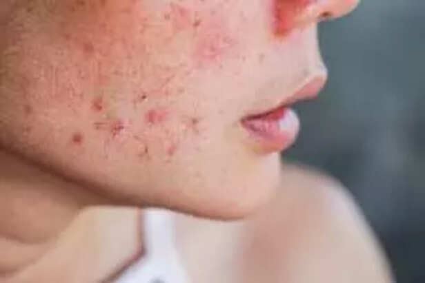 acne on woman's face with rash skin ,scar and spot that allergic to cosmetics