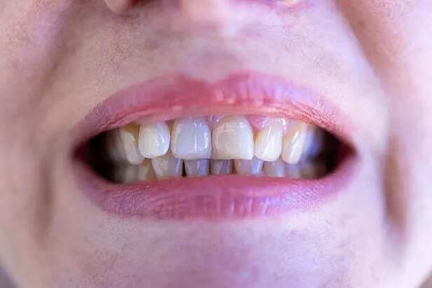 Jutting of misaligned teeth