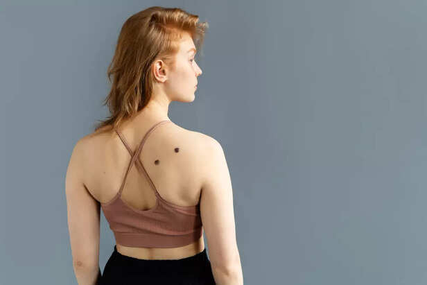 moles on lower parts