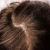 fights dandruff and dry scalp(image credit:freepik)