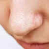 what exactly are blackheads(image credit:freepik)