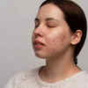 skin issues caused by pcos(image credit:freepik)