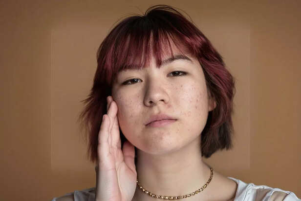 No words, just breakouts. She knows her period is near                    [image credits:Freepik]