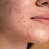 reason behind sudden pigmentation(image credit:freepik)