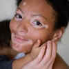 post inflammatory hyperpigmentation(image credit:freepik)