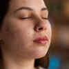melasma(image credit:freepik)