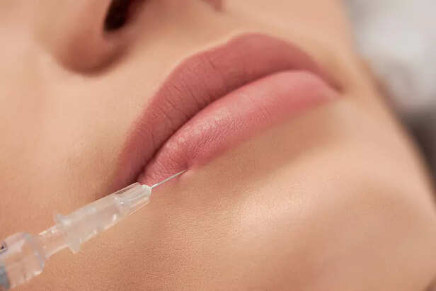 Lip fillers basics Image Credit: Freepik