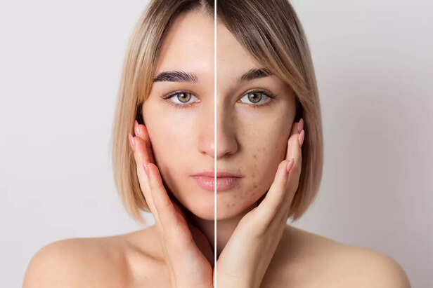 Acne to Clear skin (Image Credit: Freepik)