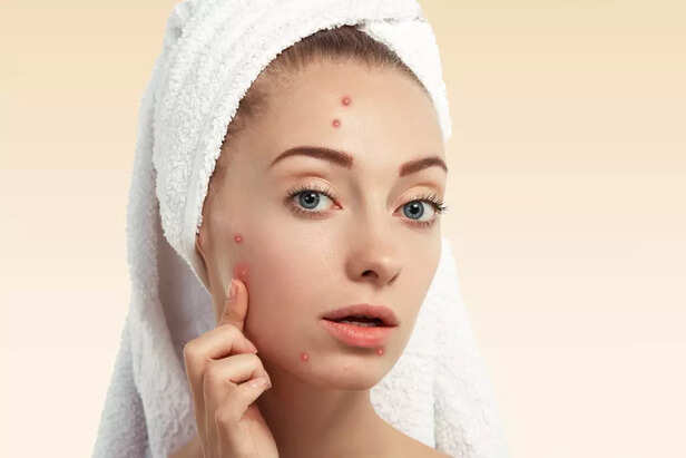 Acne-prone
