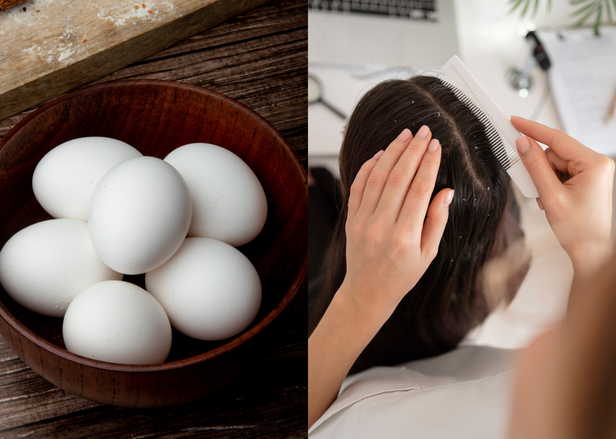 Say Goodbye to Dandruff -  Eggs & Yoghurt