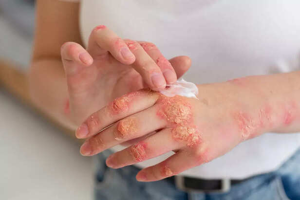 Importance of Ceramides in Skin Barrier