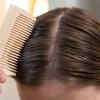 Don’t Ignore Scalp Health