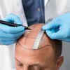 Hair Transplant Surgery - Permanent Hair Restoration