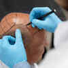 Hair Transplant Pros and Cons