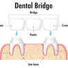 Dental Bridges
