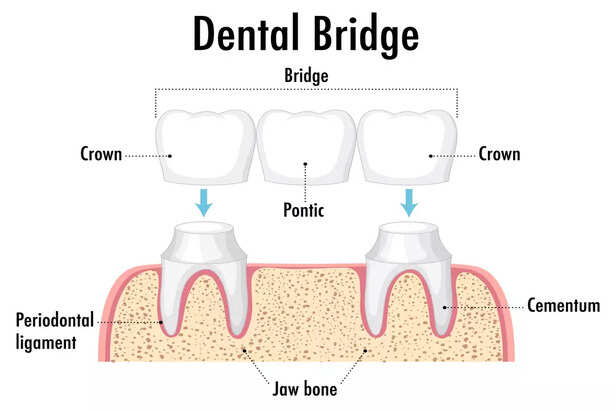 Dental Bridges