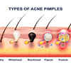 Whiteheads and Blackheads
