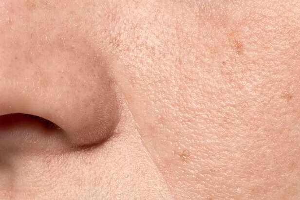 Clogged Pores