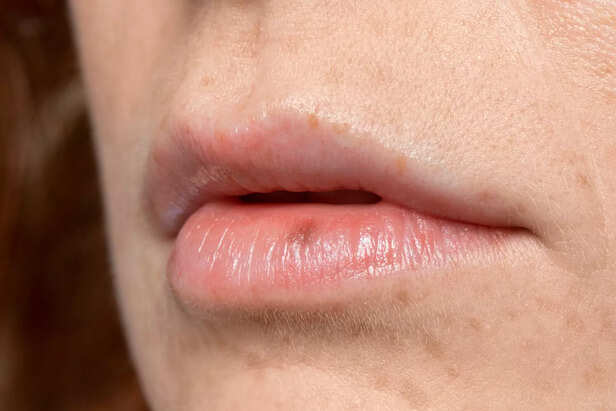 Cracked lips