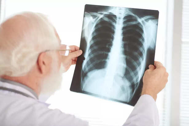 Tuberculosis