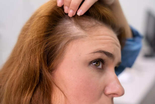 Visible hairline
