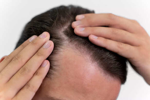 Scalp care