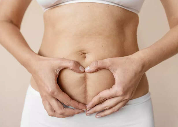 Tummy tuck