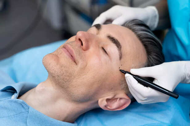 Permanent facial hair