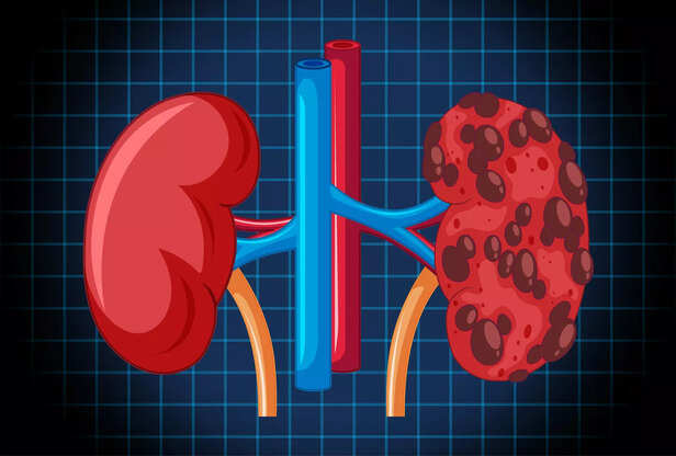 Nephrosis - Kidney Damage