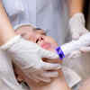 Laser skin treatments