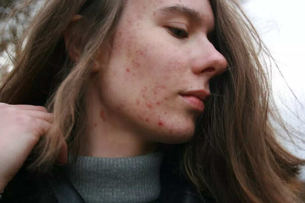 Bad gut causes acne