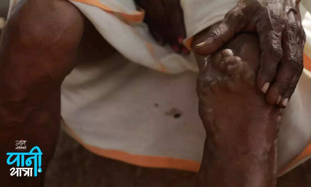 359711-fluoride-madhya-pradesh-13