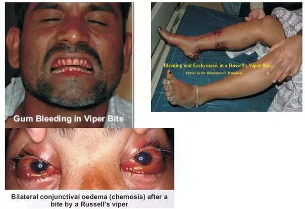 354575-snakebite-death-rural-india-health-centre-treatment-antivenom-tribal-village-cobra-viper-wildlife-5