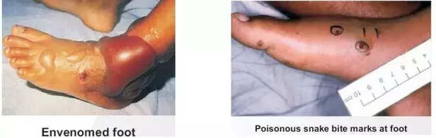 354577-snakebite-death-rural-india-health-centre-treatment-antivenom-tribal-village-cobra-viper-wildlife-3