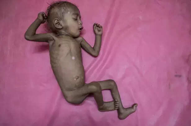 353750-malnutrition-in-india-1