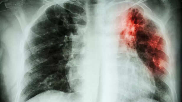 364219-tuberculosis-tb-symptoms-causes-treatment-infection-chest-pain-coughing-up-blood-feeling-tired-all-the-time-night-sweats-chi-3