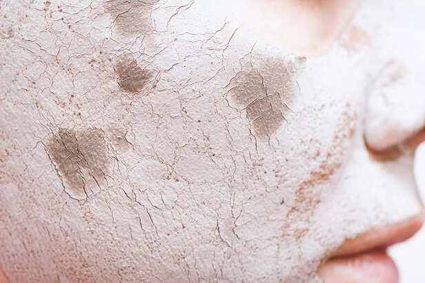 Dry Skin From Nutrients Deficiency