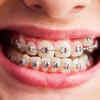 Braces
