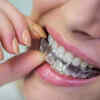 Aligners
