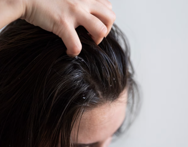 dandruff